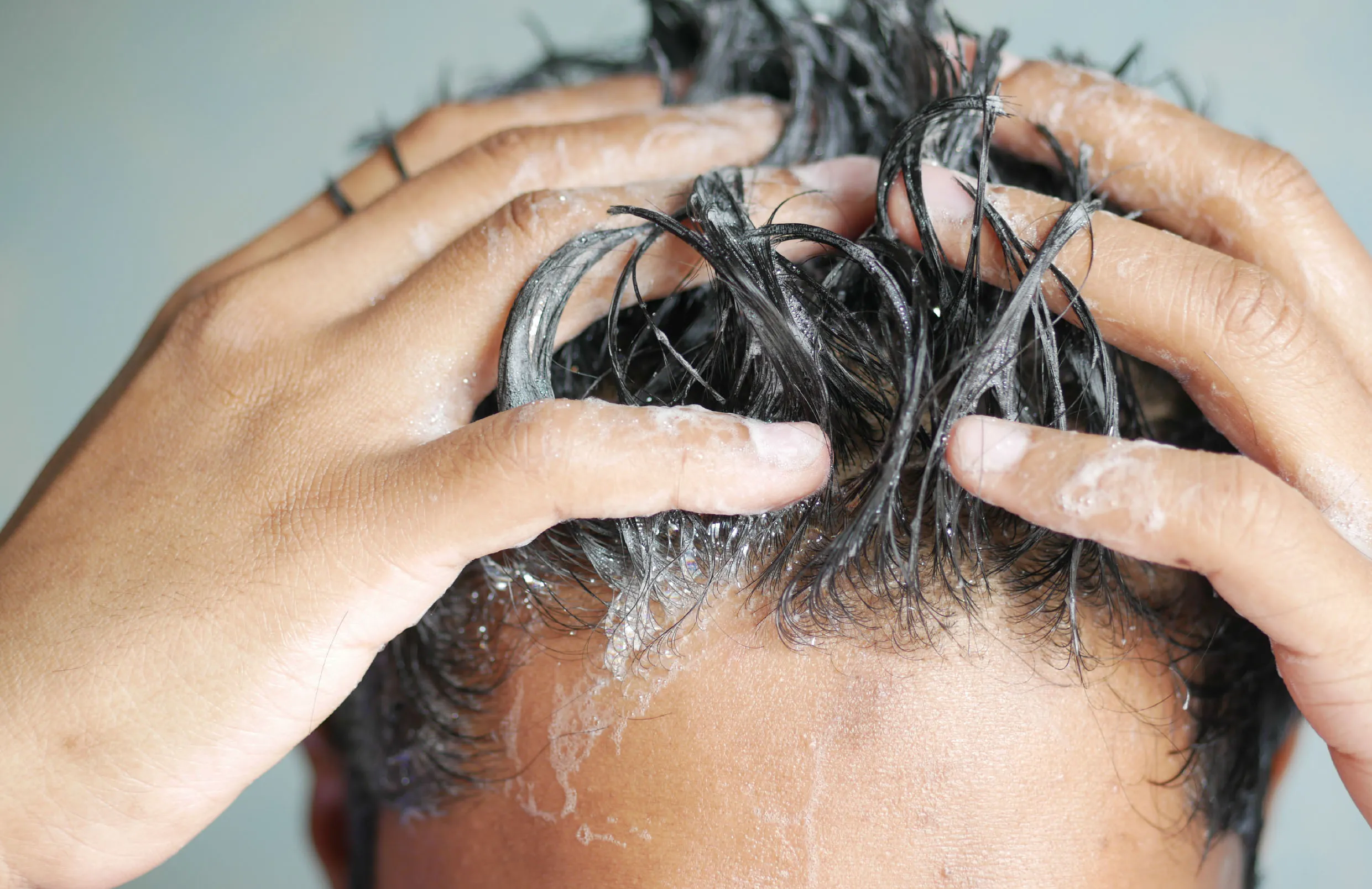 Desenvolvimento de Shampoo Natural para Dermatite Seborreica