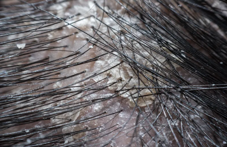 Desvendando a Dermatite Seborreica